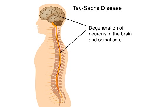Bệnh Tay-Sachs 