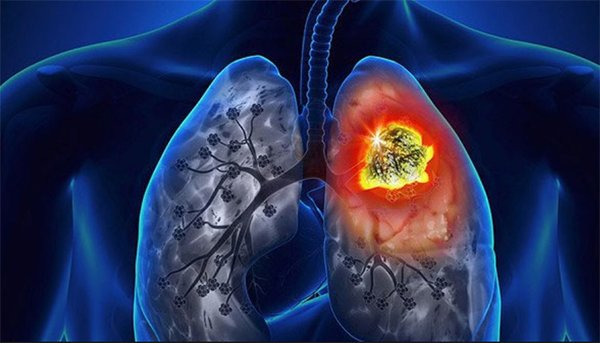 Viêm phổi gây suy giảm chức năng phổi